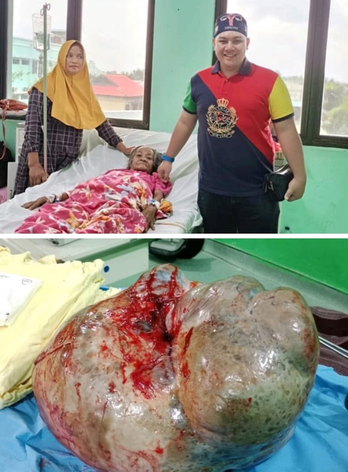 Cerita Ibu Kamariah, Penderita Kista Seberat 15 Kg yang Diselamatkan dr. Agung Khoiri